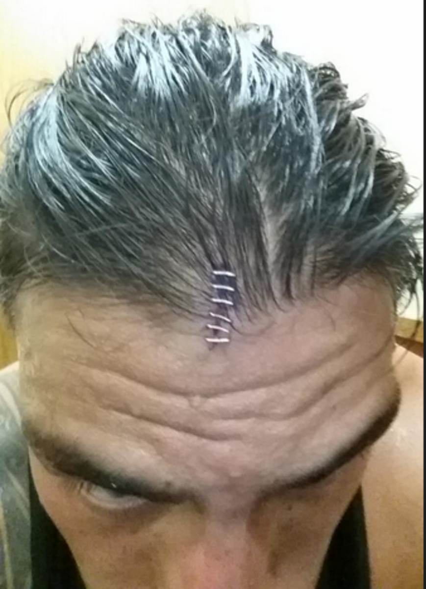 Photo Roman Reigns Receives Six Staples After Getting Busted Open On Raw Wwe Wrestling News World